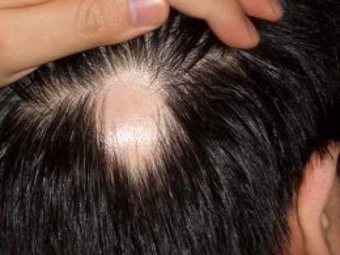 Alopecia areata