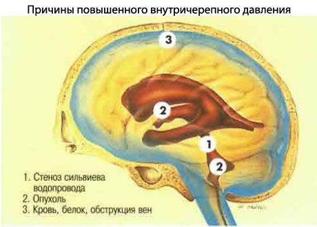 Nadagdagang presyon ng intracranial 