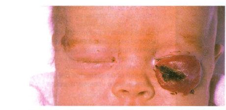 Hemangioma ng mas mababang eyelid. 