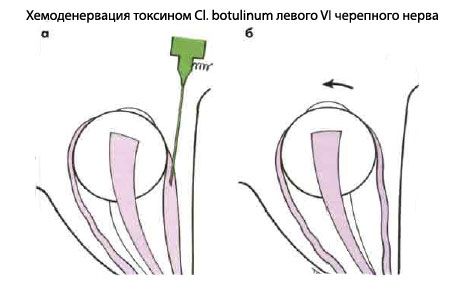 Strabismus - Operasyon