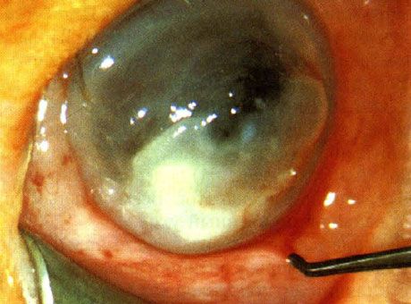 Keratitis na dulot ng Pseudomonas sa isang bagong panganak.  Hindi itinutukoy ang mga bagay na hinuhulaan