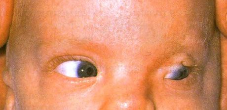 Fraser Syndrome.  Hindi kumpleto ang cryptophthalmos ng kaliwang mata.