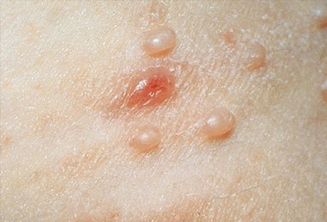 Molluscum contagiosum: mga larawan