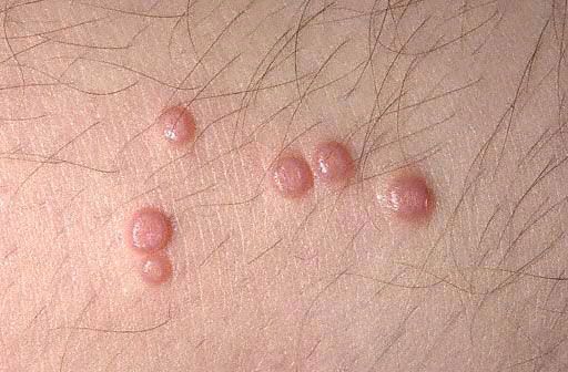 Molluscum contagiosum: mga larawan