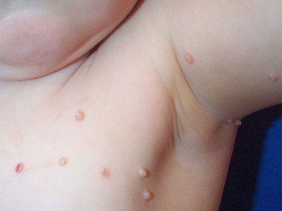 Molluscum contagiosum Photo