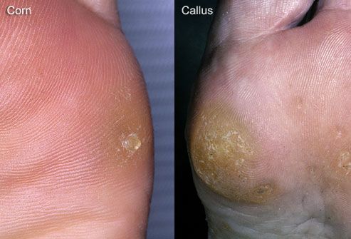 Mga hemorrhage at calluses