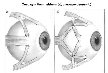 Strabismus - Operasyon