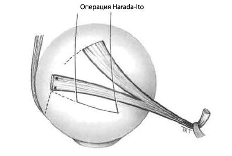 Strabismus - Operasyon