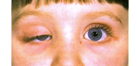 Unilateral congenital ptosis