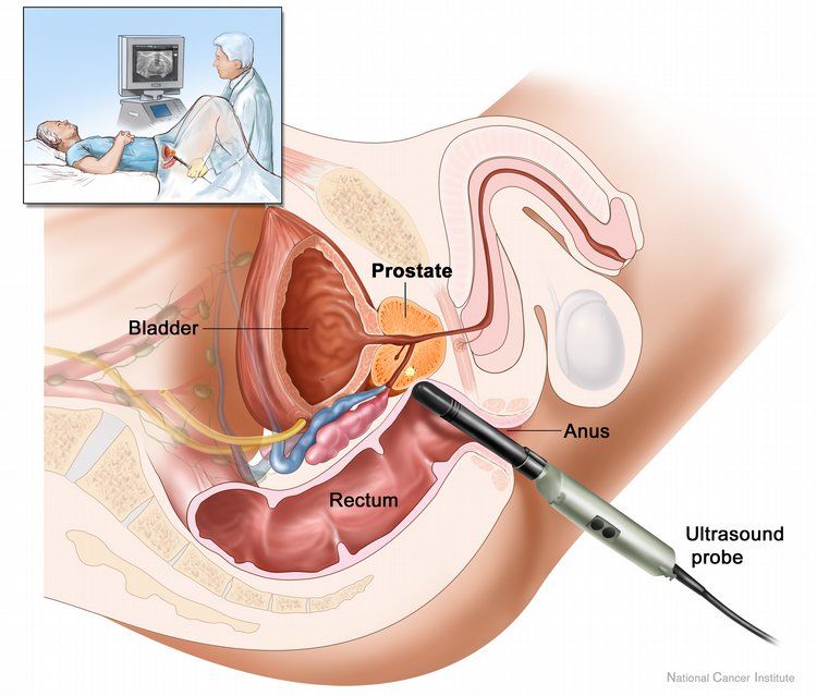 Ang isang epektibong gamot laban sa kanser sa prostate batay sa tsaa at ginto ay nalikha