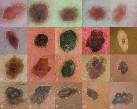 Natagpuan ng mga siyentipiko ang isang gene na gumaganap ng isang mahalagang papel sa pagpapaunlad ng melanoma